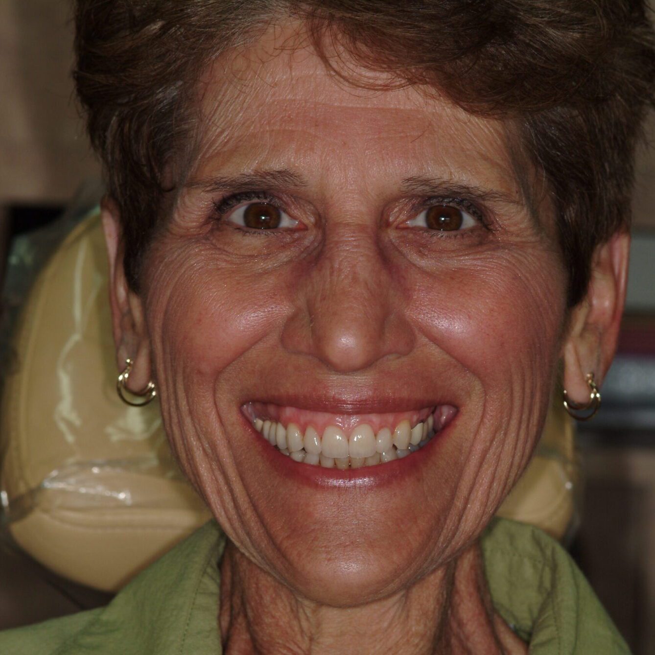 Ann – Face After After