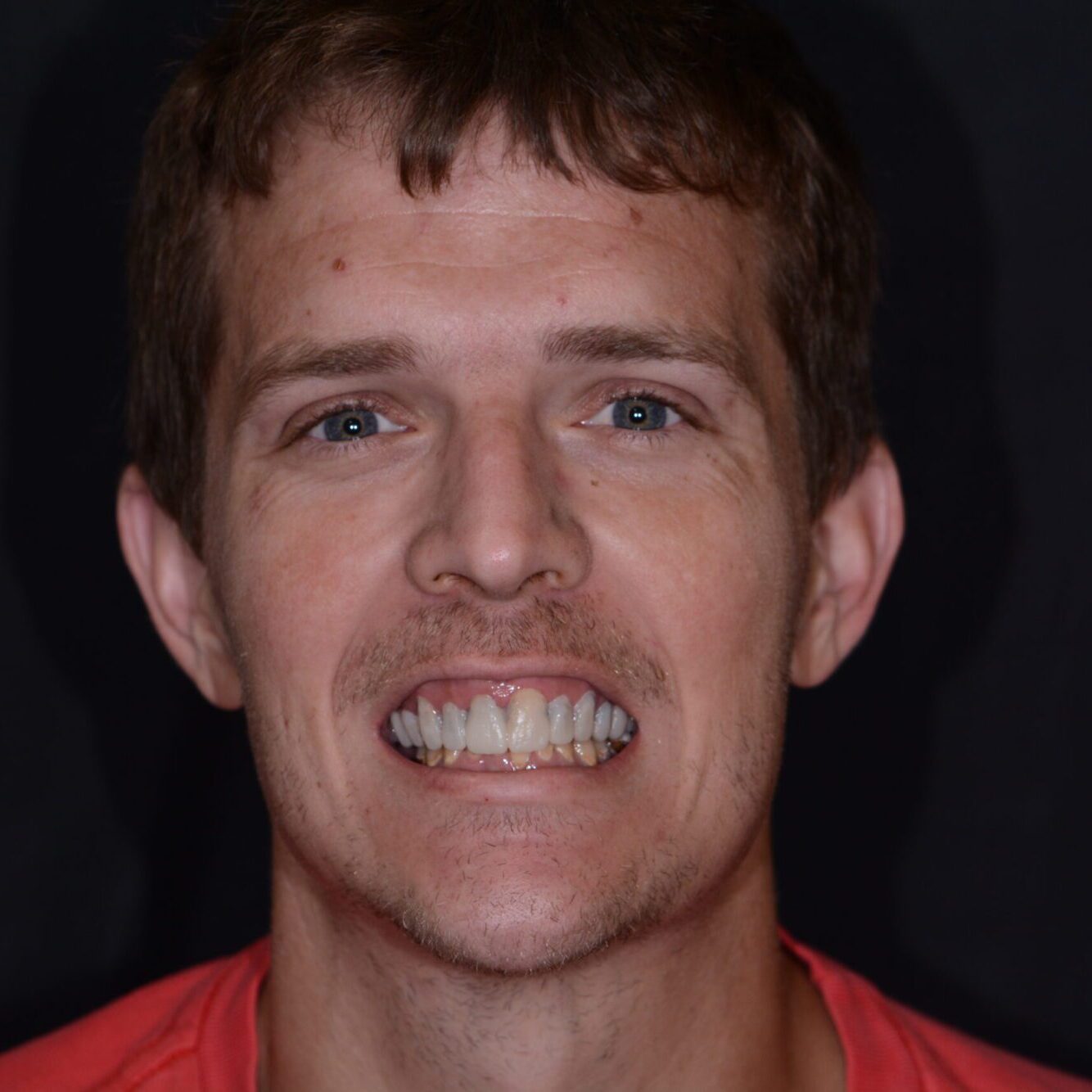 Chris – Face After After