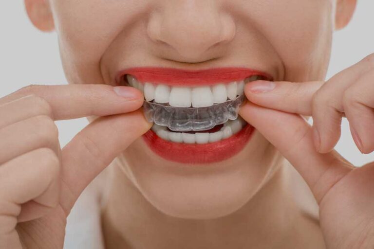 Taking Care of Your Invisalign Trays