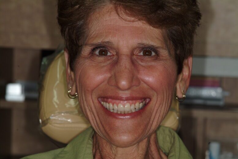 Ann – Face After After