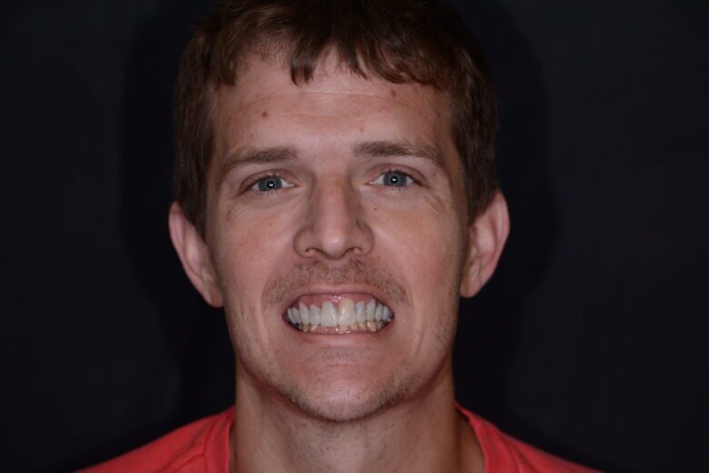 Chris – Face After After