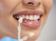 woman with dental veneers