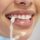 woman with dental veneers