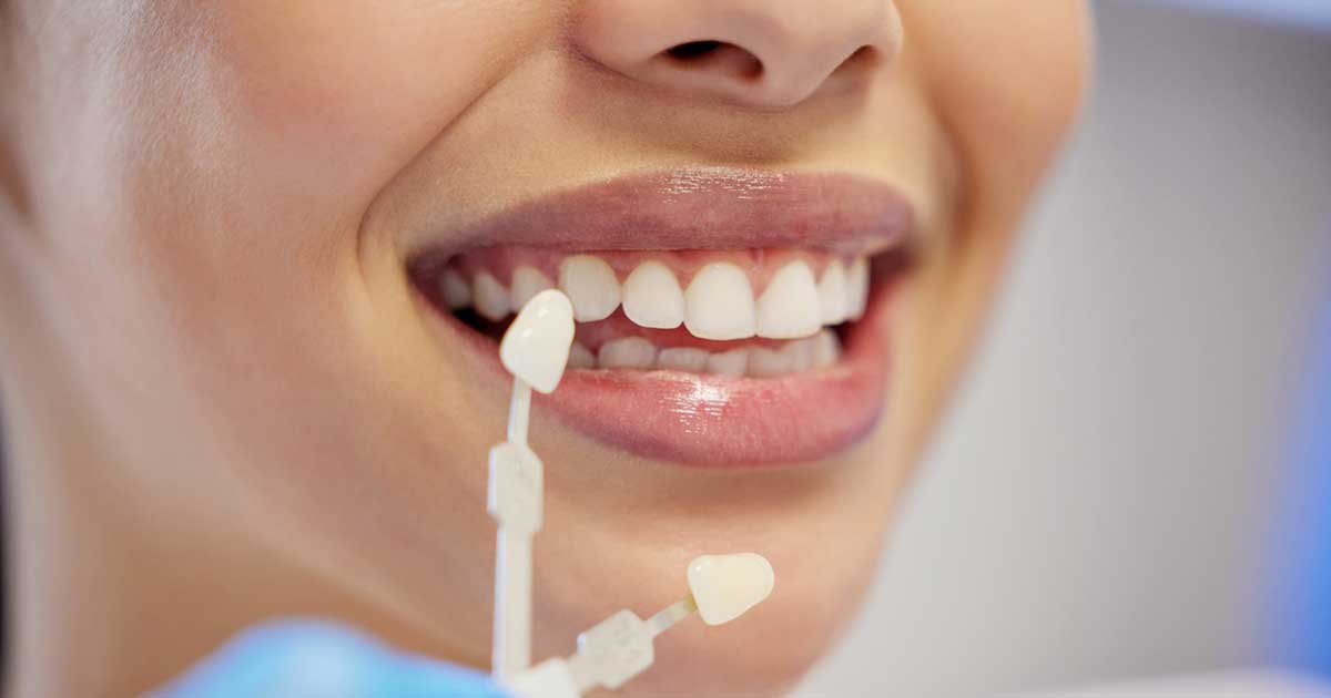 dental-veneers woman with dental veneers