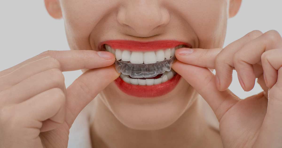Taking-Care-of-Your-Invisalign-Trays Taking Care of Your Invisalign Trays